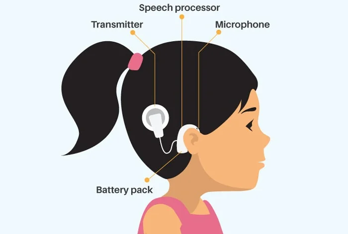 COCHLEAR IMPLANTATION AND REHABILITATION